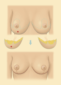 Breast Cancer Experts Oncoplastic Surgery