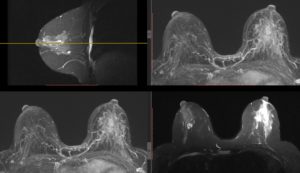 Breast Cancer Ironwood Cancer & Research Centers