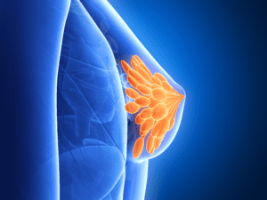 Breast Malignancy Sub Specialty Ironwood Cancer & Research Centers