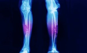 Hereditary Sarcoma