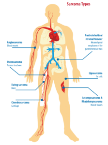 Hereditary Sarcoma