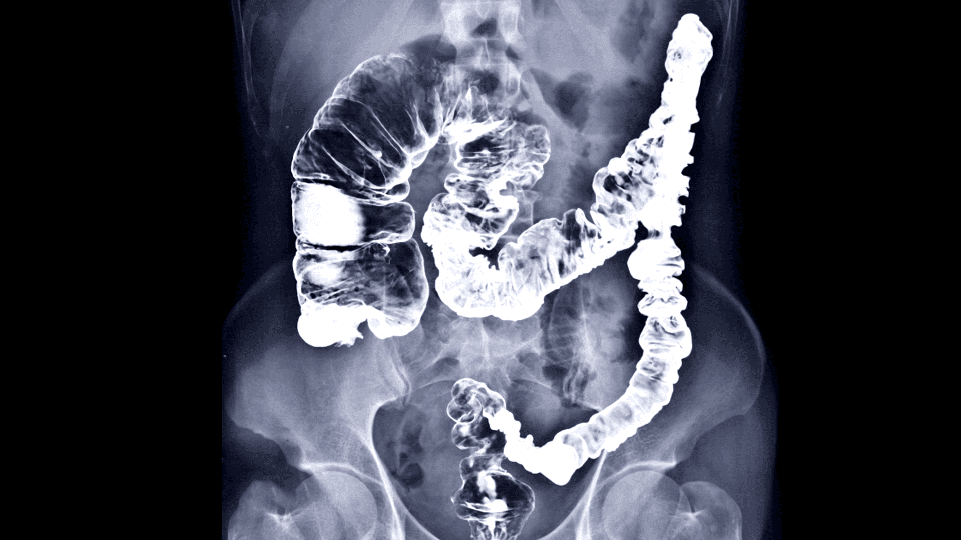 Featured image for “Colorectal Cancer”